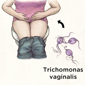 trichomonas-std-testing