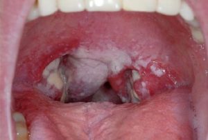 Chlamydia-in-throat-oral sex