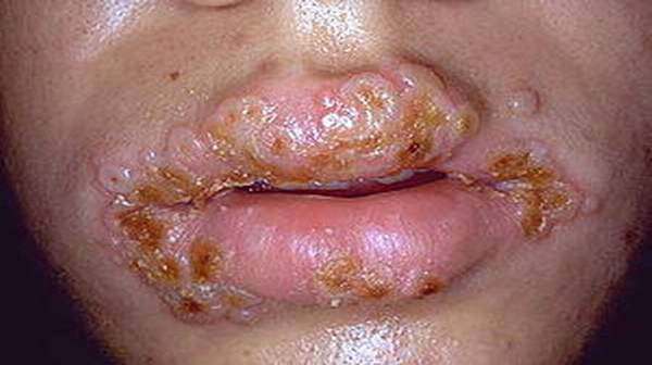 female oral gonorrhea symptoms