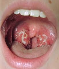 Oral-gonorrhea-sex-symptoms