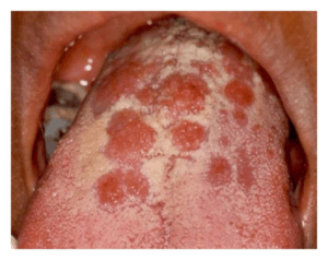 Oral-secondary-syphilis-sex