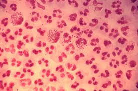 drug-resistant-gonorrhea