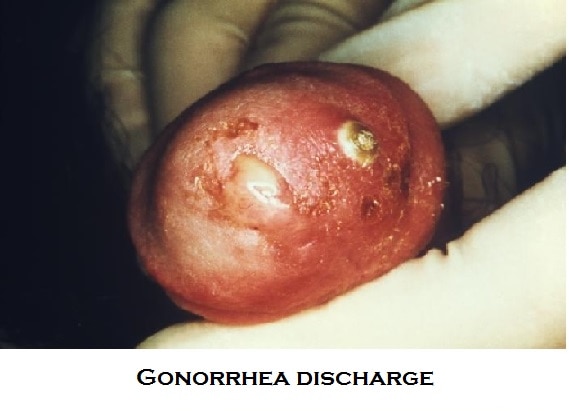 Gonorrhea-discharge-on-penis