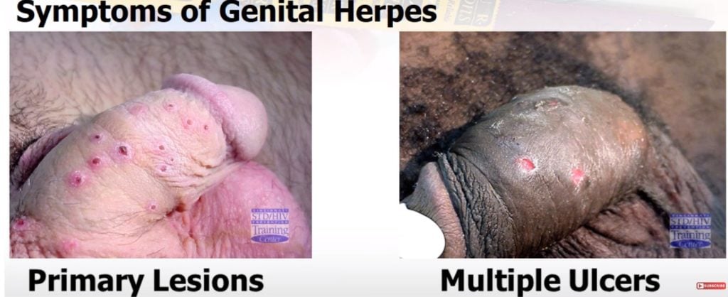 herpes-on-penis-std-men