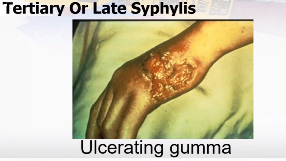 Tertiary-syphilis-ulcerating-gumma