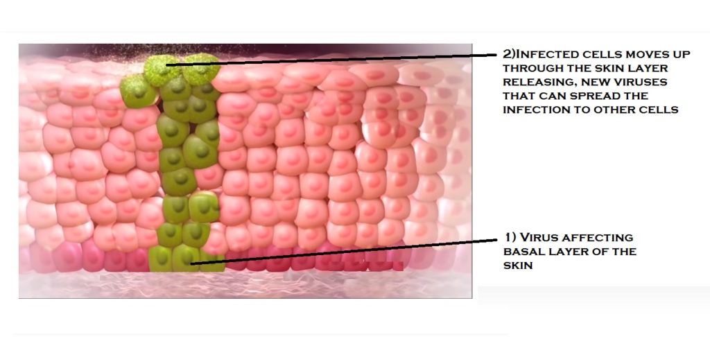 hpv-spread-causing-warts