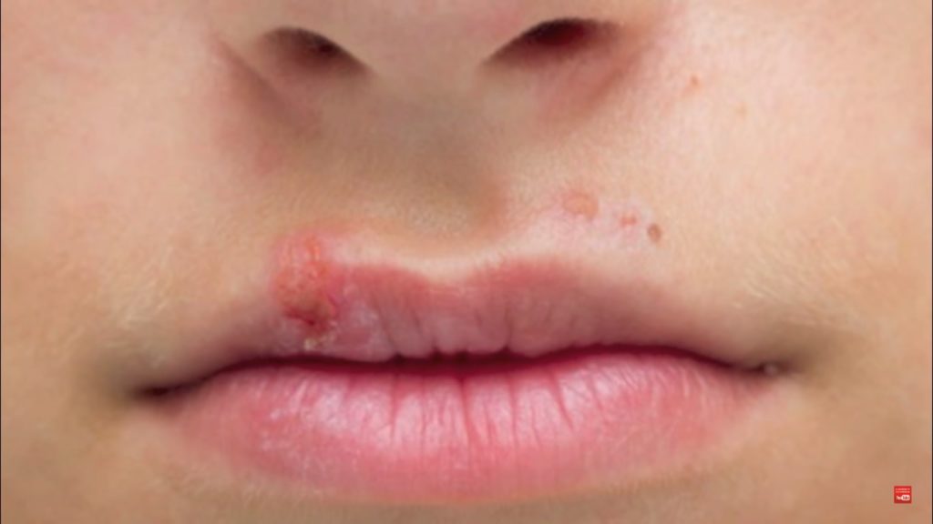 Herpes-from-kissing
