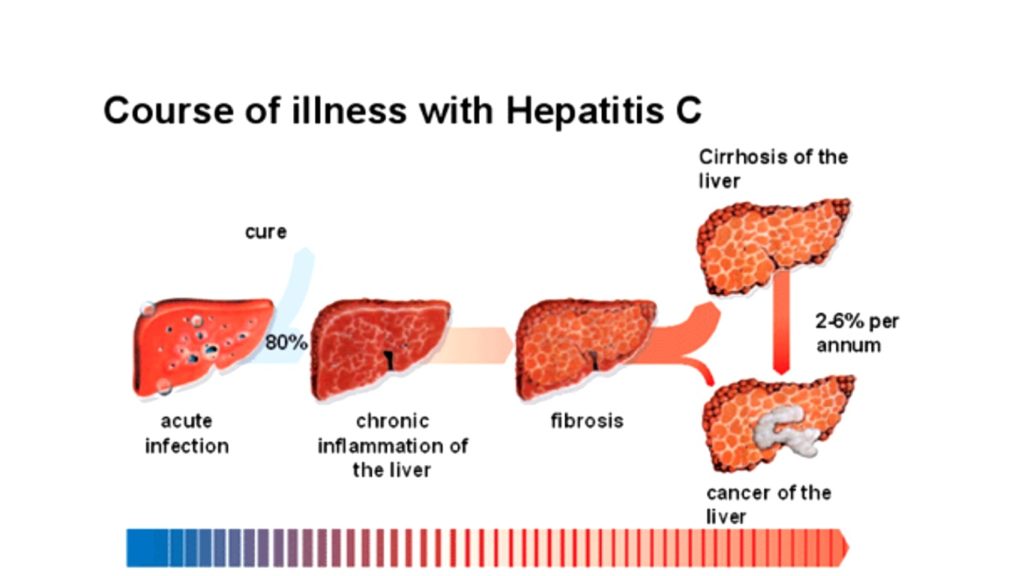 Hepatitis-c-cancer-chronic-stage