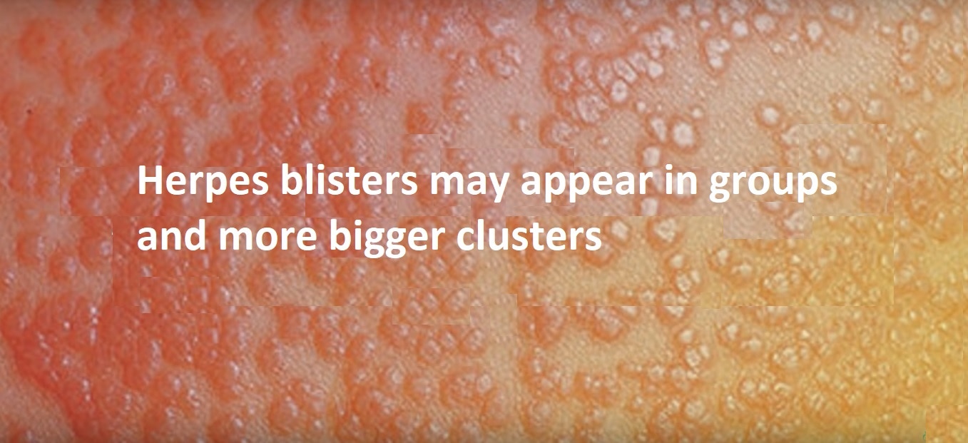 Herpes-blisters-big-clusters