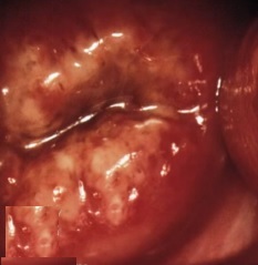 cervix-of-asymptotic-herpes-patient