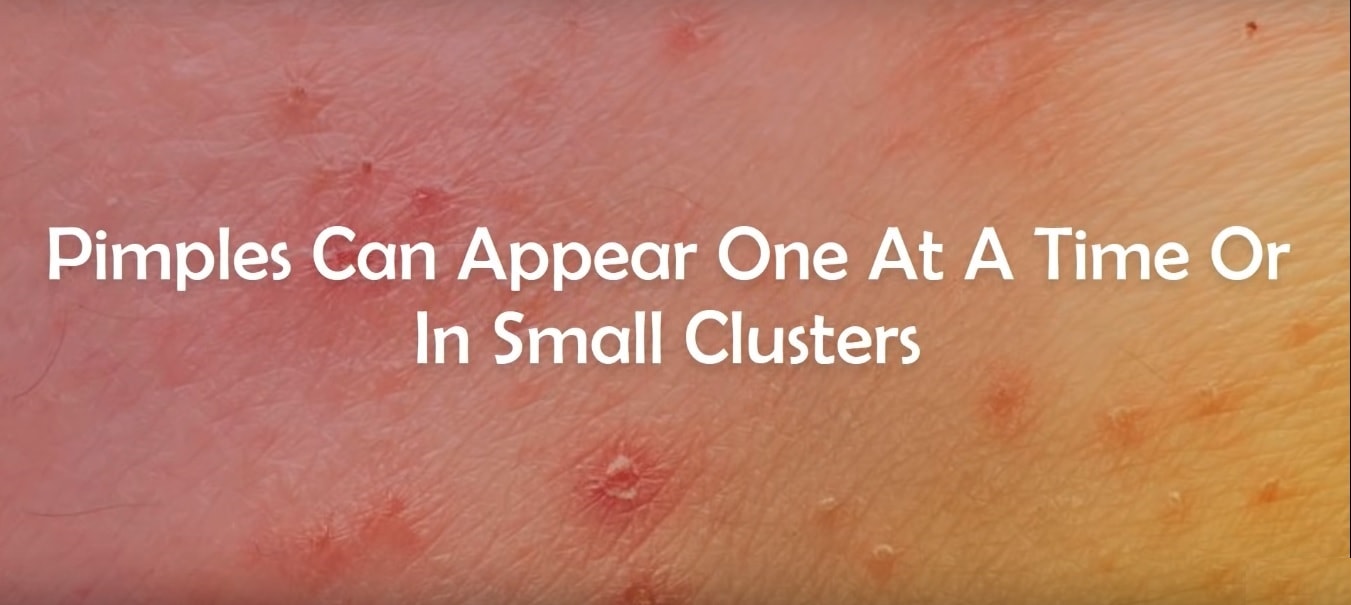 genital-pimples-small-clusters