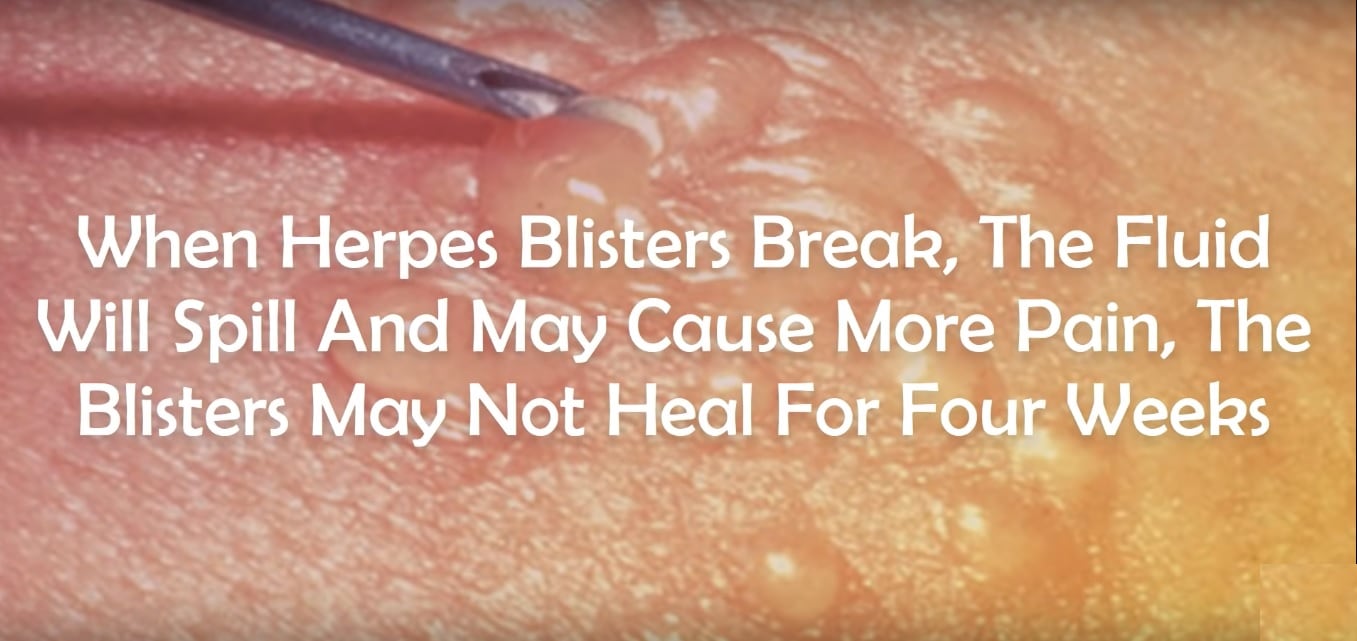 herpes-blister-break-fluid-vs-pimple-break