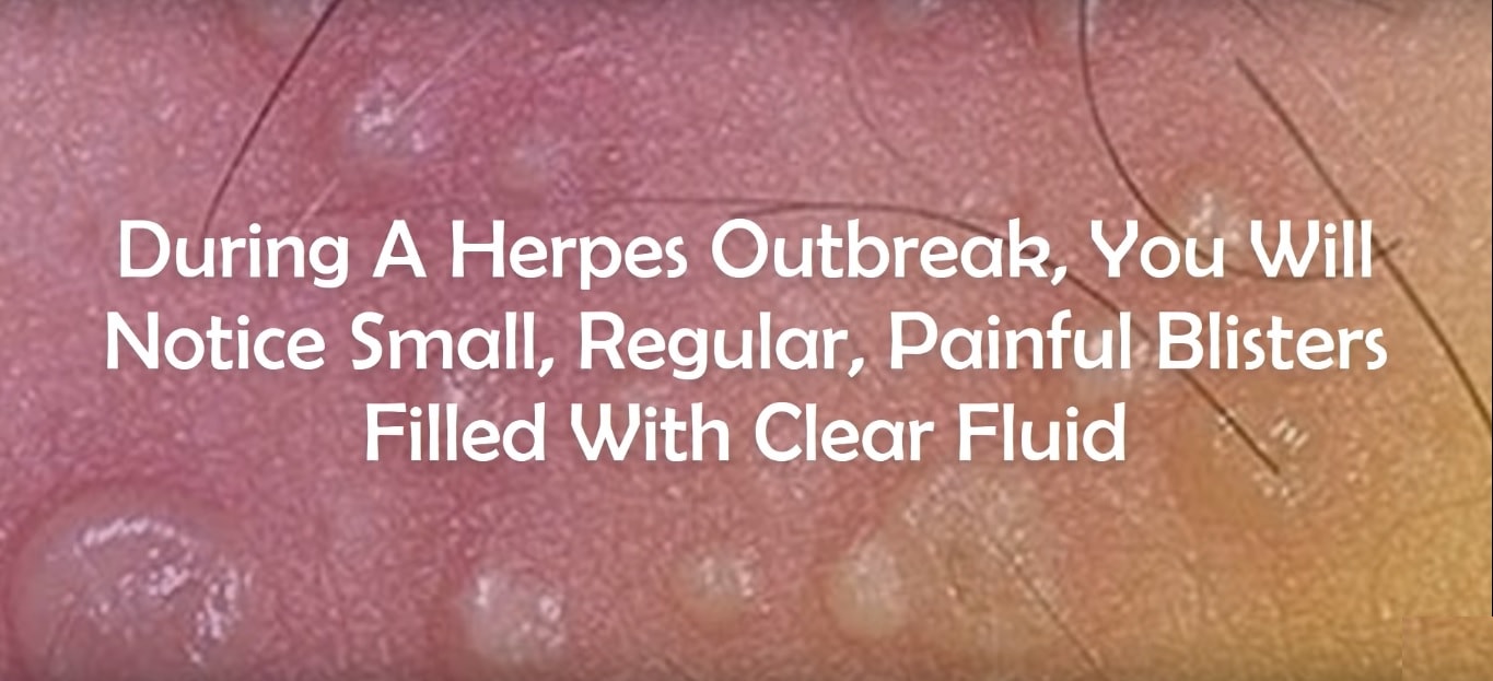 ingrown hair vs herpes