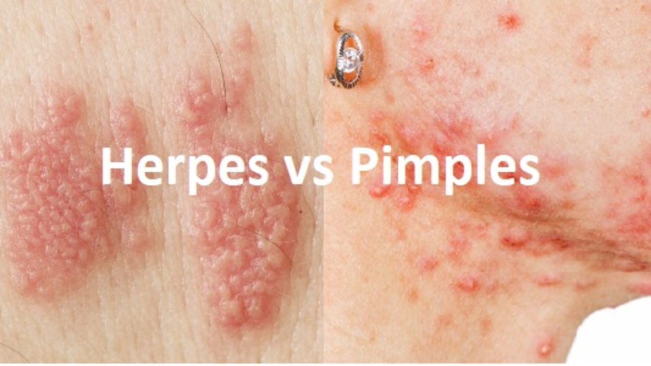 Genital herpes usually comes from the virus called herpes simplex 2 hsv 2. 