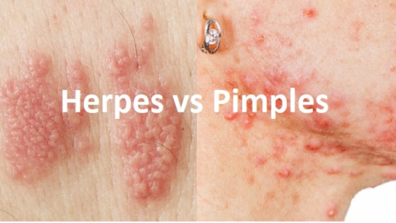 Difference Between Herpes Std Vs Genital Grains Vs Pimples Or Ingrown Hair Cyst Std Testing Near Me