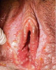 primary-genital herpes