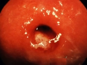 asymptotic-gonorrhea-patient-cervix-vaginal-std