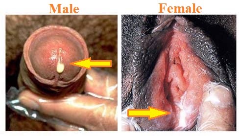 STD-discharge gonorrhea-female