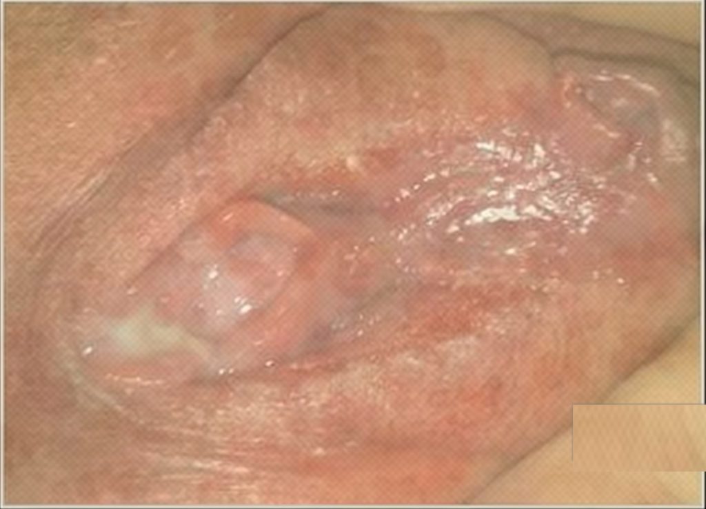 Trichomonas-vaginitis