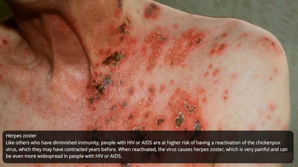 HIV-rash-herpes--zoster-hiv-how-std-rashes-looks-like