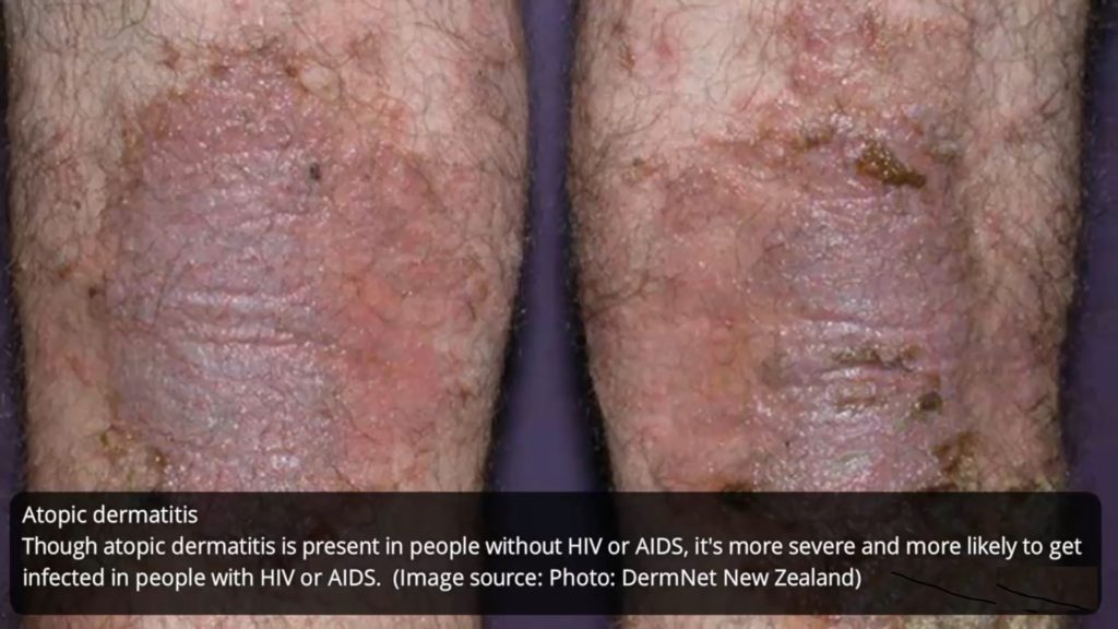 HIV-rash-on-atopic--dermatitis-how-std-rashes-looks-like