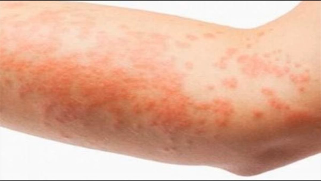 What does HIV rash looks like? - STD Testing Near Me