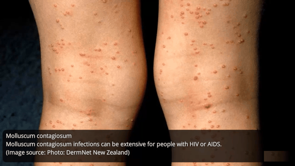 HIV-rash-on-molluscums-contagiosum-how-std-rashes-looks-like