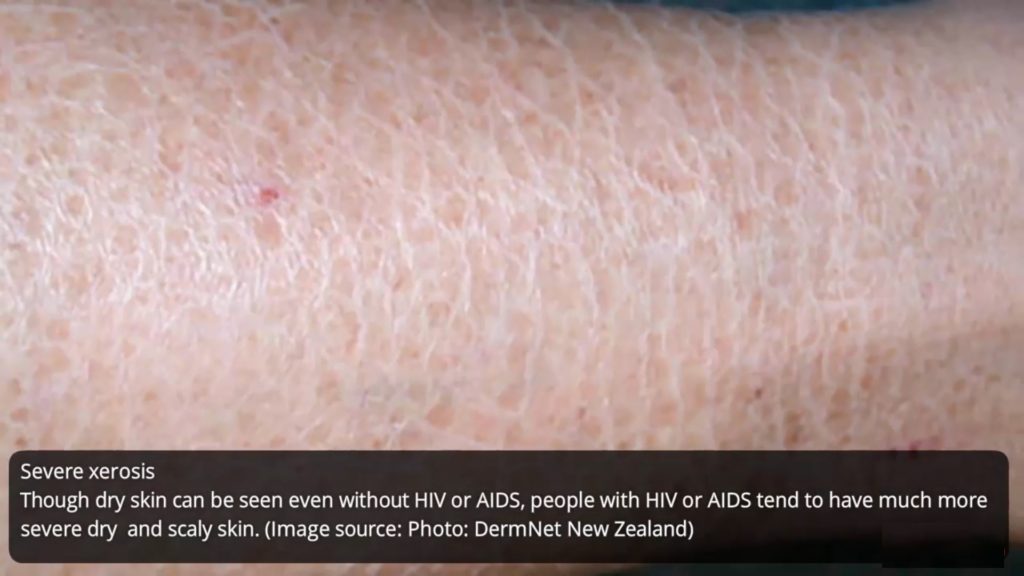 HIV-rash-severe-xerosis-on-scaly-dry-skin-how-std-rashes-looks-like