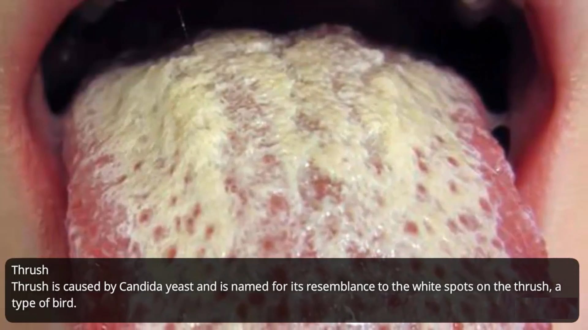 What does HIV rash looks like? - STD Testing Near Me