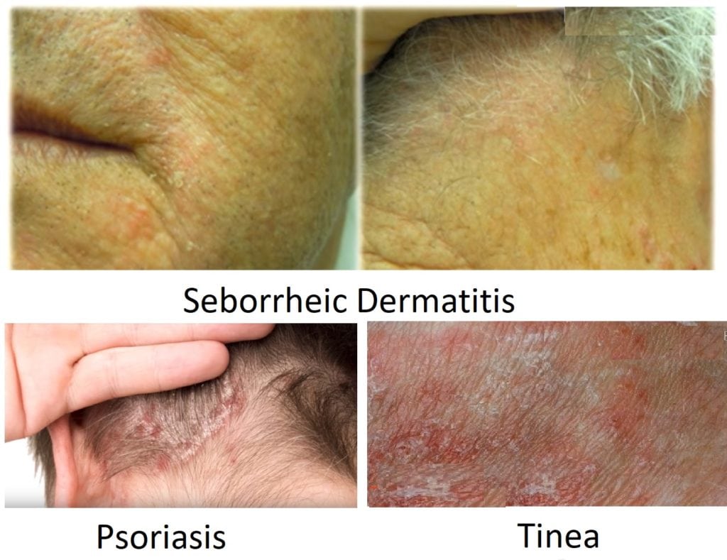 Seborrheic-Dermatitis-Psoriasis-Tinea