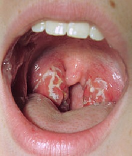 Pharyngeal-gonorrhea