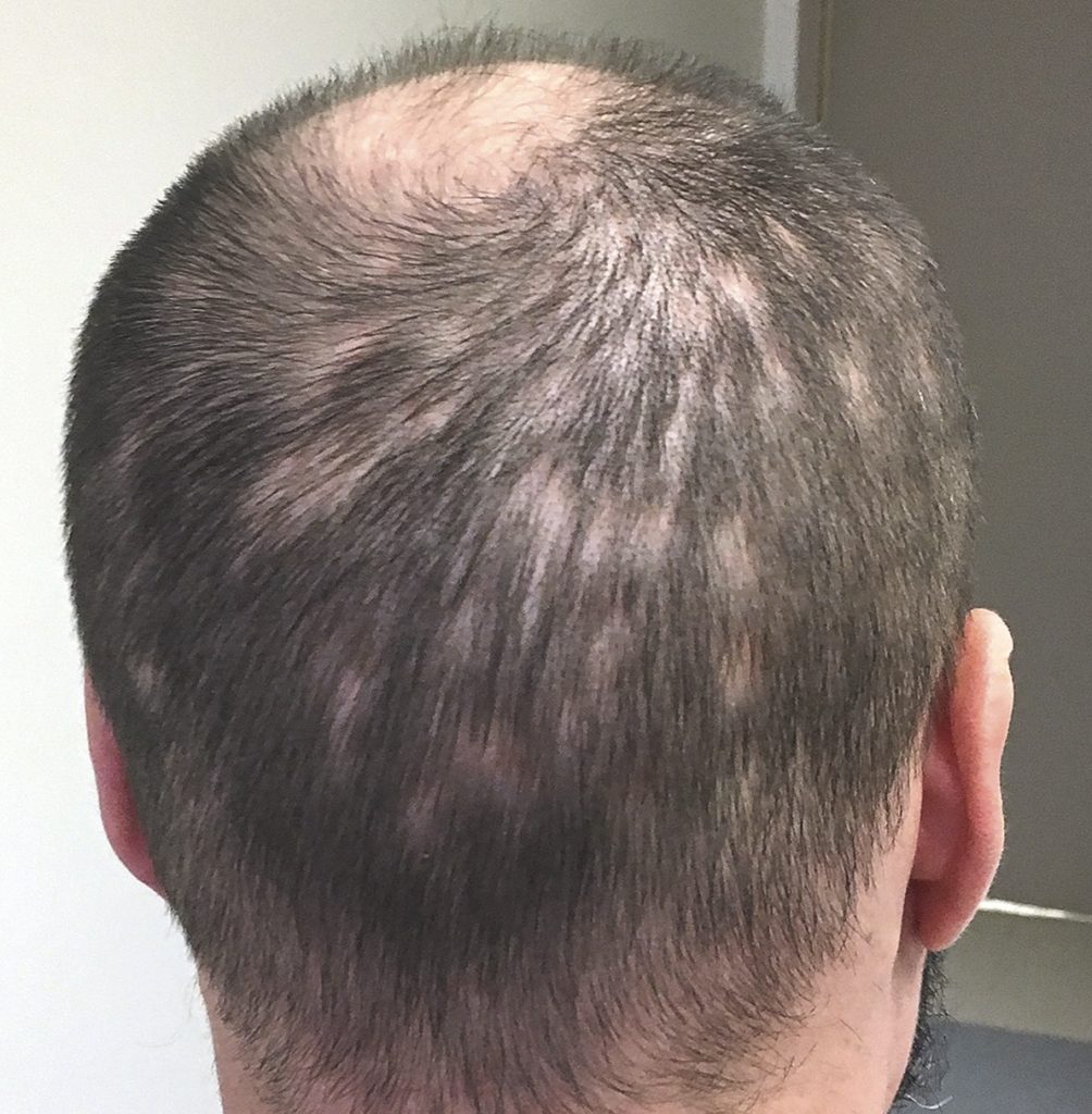 Hair loss due to STD? Yes, that's possible check out different symptoms -  STD Testing Near Me
