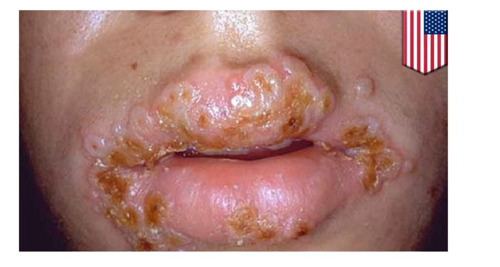 chlamydia-on-lips