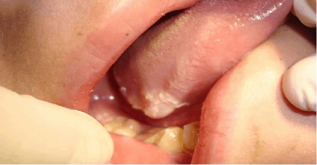 chlamydia-on-tongue