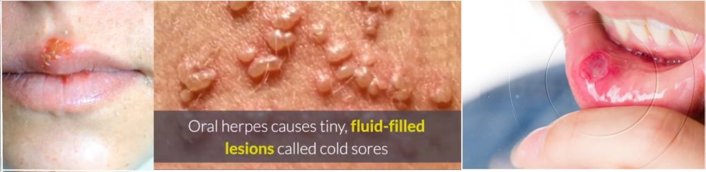 cold-sores-herpes-hsv1-lesions-scaled