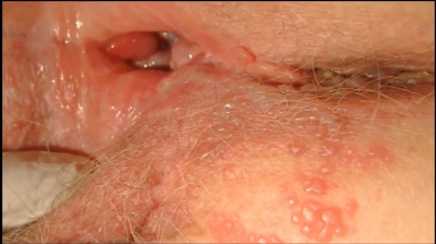 Herpes simplex