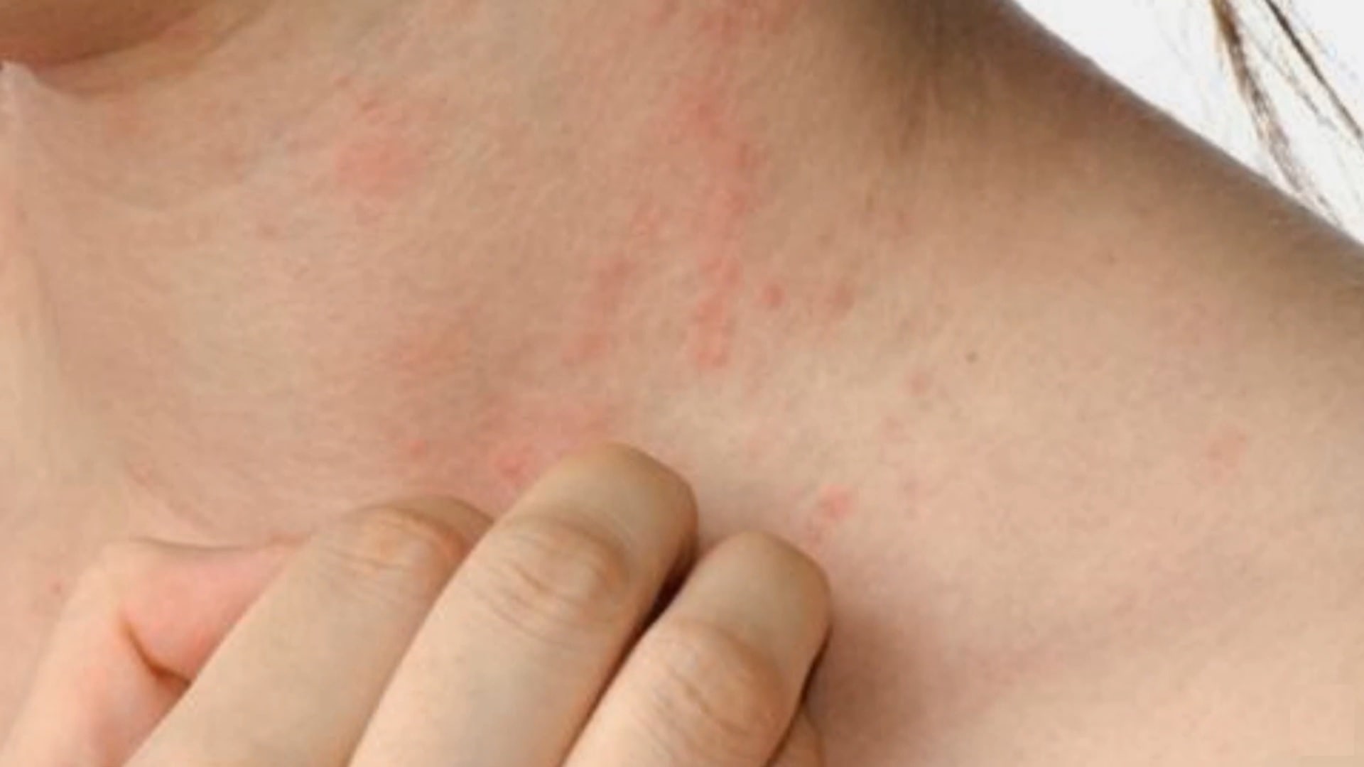 Early-signs-of-hiv-neck-rash