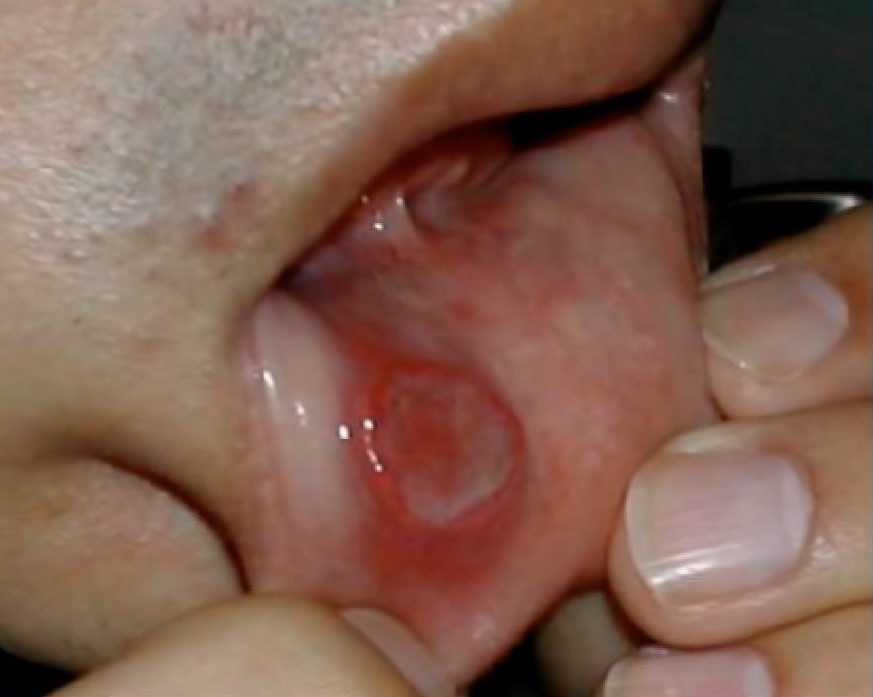 early-signs-hiv-mouth-ulcer