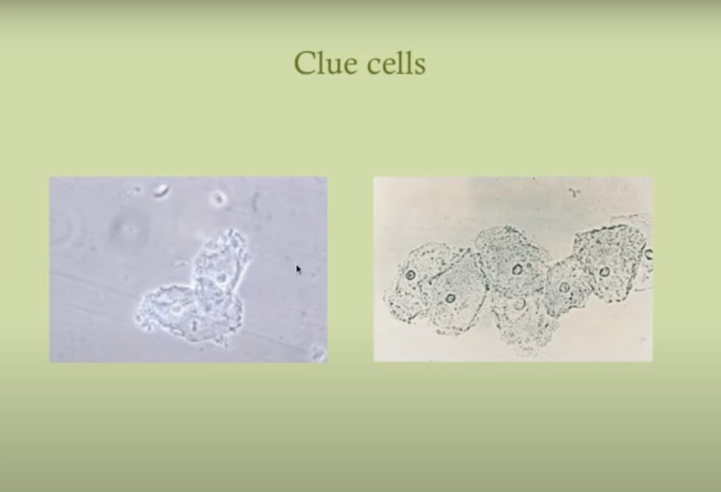 clue cells bv discharge
