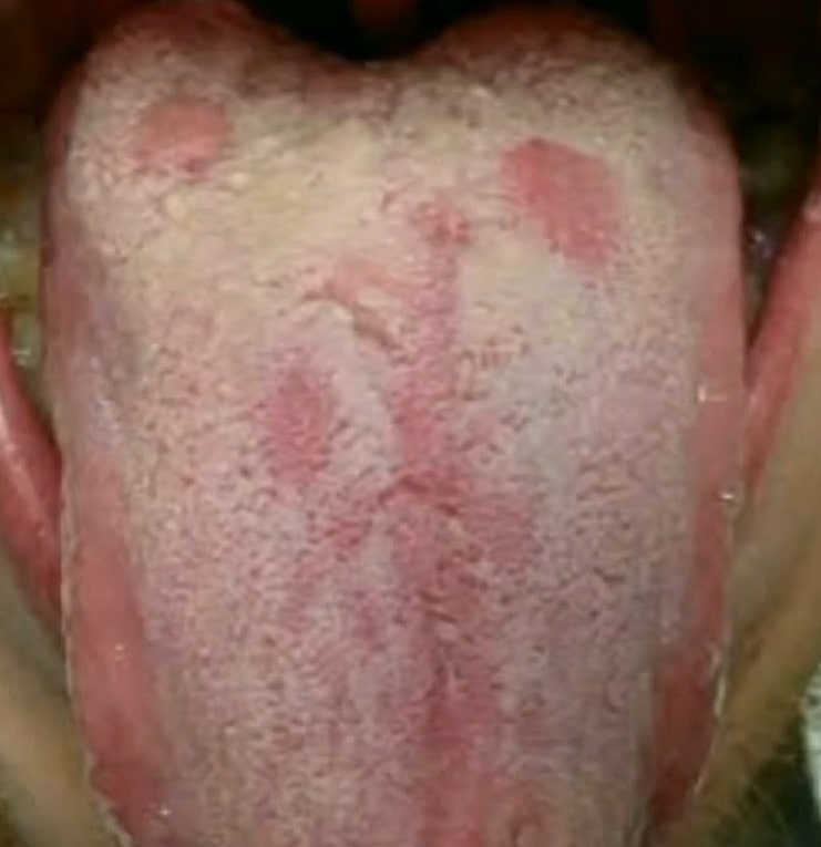 syphilis-tongue-Syphilitic-glossitis-syphilis-tongue