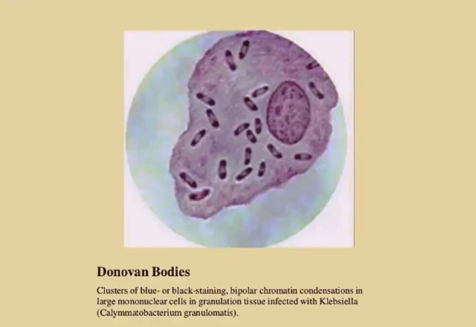Granuloma Inguinale Or Donovanosis Pictures In All Its Stages STD granuloma-inguinale-or-donovanosis-pictures-in-all-its-stages-std