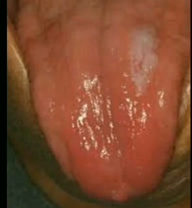 interstitial-glossitis-syphilis-tongue