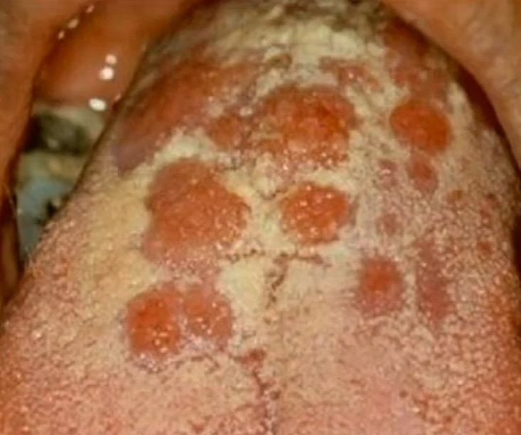 syphilis-tongue