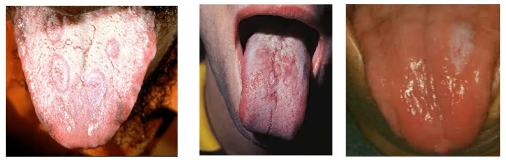 syphilis-tongue