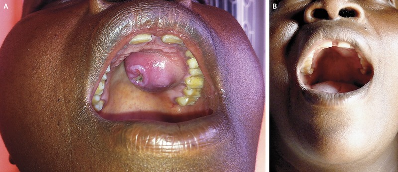 syphilitic-gumma-on-tongue-tertiary-syphilis
