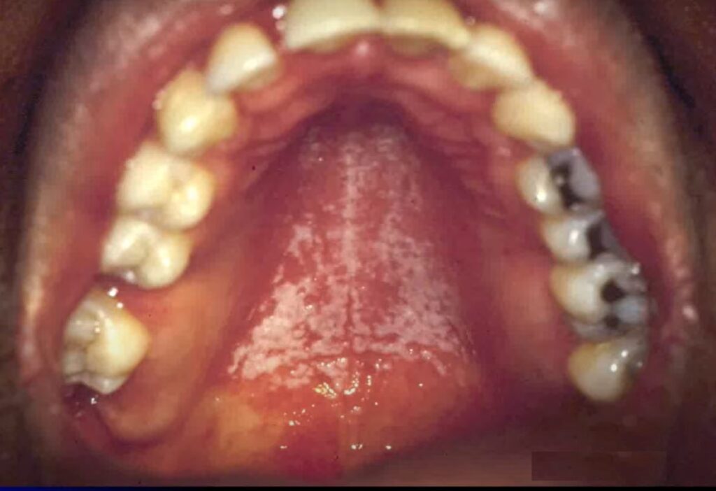 Pseudomembranous-Candidiasis-hiv-tongue