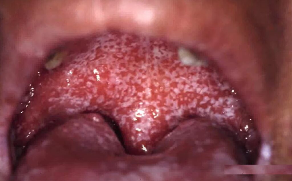 severe-Pseudomembranous-Candidiasis-hiv-tongue
