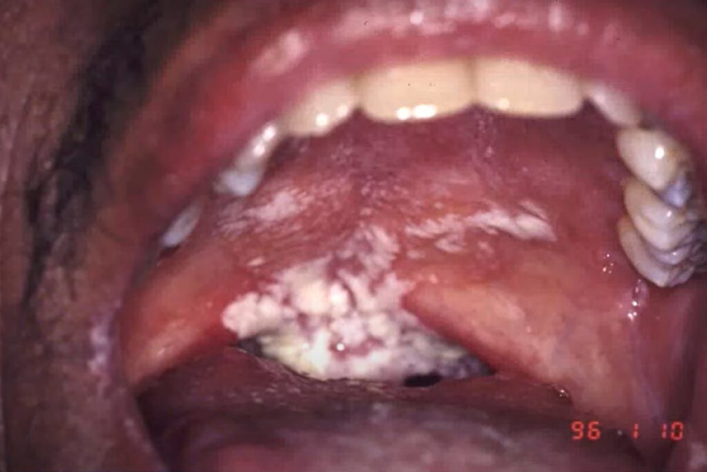 esophageal-candidiasis-hiv-throat-tongue