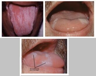 HIV-tongue-lesions-on-the-tongue