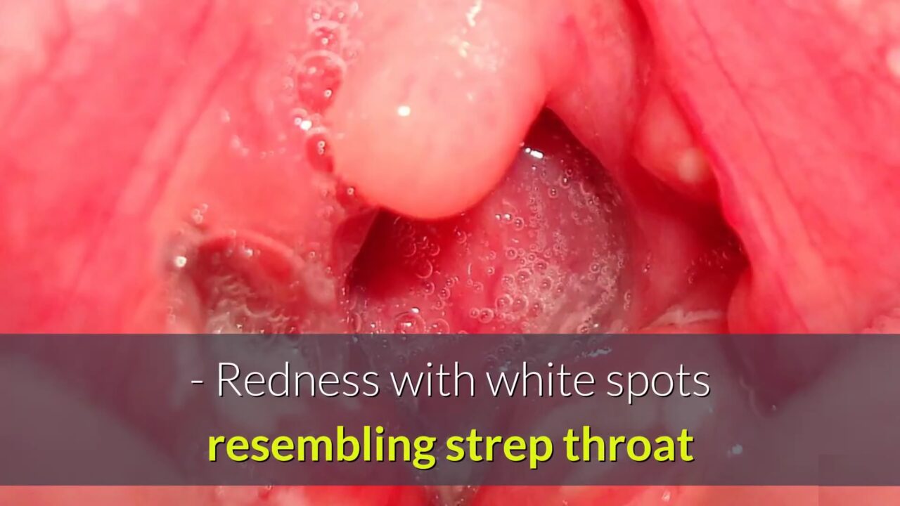 Chlamydia in Throat: Pictures, Symptoms diagnosis - STD Testing Near Me